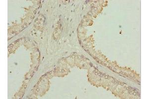 Immunohistochemistry of paraffin-embedded human prostate cancer using ABIN7169213 at dilution of 1:100 (ULK3 antibody  (AA 44-240))