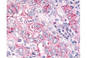 Anti-USP4 / UNP antibody IHC of human Lung, Non-Small Cell Carcinoma. (USP4 antibody  (N-Term))