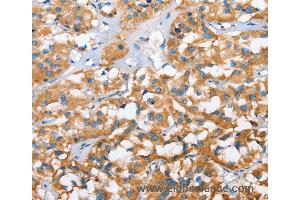 Immunohistochemistry of Human thyroid cancer using CXCL14 Polyclonal Antibody at dilution of 1:40