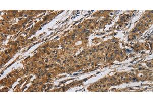 Immunohistochemistry of paraffin-embedded Human gastric cancer tissue using Claudin 2 Polyclonal Antibody at dilution 1:50 (Claudin 2 antibody)