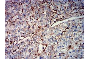 Immunohistochemical analysis of paraffin-embedded liver cancer tissues using MUC16 mouse mAb with DAB staining. (MUC16 antibody  (AA 1-200))