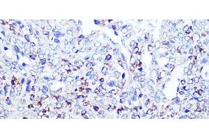 Immunohistochemistry of paraffin-embedded Human oophoroma using CD68 Polyclonal Antibody at dilution of 1:100 (40x lens). (CD68 antibody)