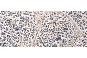 Immunohistochemistry of paraffin-embedded Human breast cancer tissue using PAIP1 Polyclonal Antibody at dilution of 1:80(x200) (PAIP1 antibody)