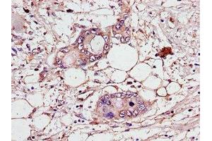 Immunohistochemistry of paraffin-embedded human pancreatic cancer using ABIN7147419 at dilution of 1:100 (CEP7 (AA 99-276) antibody)