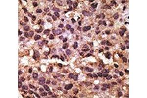 IHC analysis of FFPE human breast carcinoma tissue stained with the BNIP3 antibody (BNIP3 antibody  (AA 152-187))