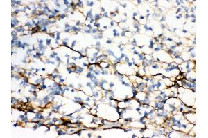 Anti- Versican Picoband antibody, IHC(P) IHC(P): Human Glioma Tissue (Versican antibody  (N-Term))