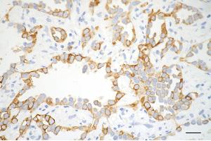 Immunohistochemistry was performed on paraffin-embedded human lung adenocarcinoma using CD8 alpha antibody (ABIN7797987), 1:200).