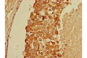 Immunohistochemistry of paraffin-embedded human breast cancer using ABIN7153717 at dilution of 1:100 (GFRA1 antibody  (AA 230-385))