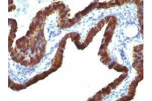 Formalin-fixed, paraffin-embedded human Ovarian Carcinoma stained with Cytokeratin 7 Monoclonal Antibody (KRT7/760 + OV-TL12/30) (Cytokeratin 7 antibody)