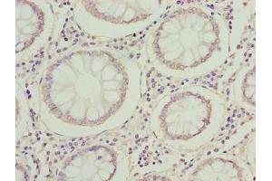 Immunohistochemistry of paraffin-embedded human colon cancer using ABIN7142353 at dilution of 1:100 (MRPL14 antibody  (AA 1-145))