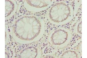 Immunohistochemistry of paraffin-embedded human colon cancer using ABIN7142353 at dilution of 1:100 (MRPL14 antibody  (AA 1-145))
