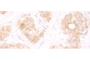 Immunohistochemistry of paraffin-embedded Human liver cancer tissue using TRMT1 Polyclonal Antibody at dilution of 1:25(x200) (TRMT1 antibody)