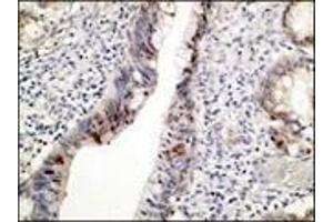 Immunohistochemistry (IHC) image for anti-Tumor Protein P53 (TP53) (N-Term) antibody (ABIN870343) (p53 antibody  (N-Term))