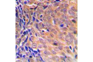 Immunohistochemical analysis of COPS3 staining in human breast cancer formalin fixed paraffin embedded tissue section. (COPS3 antibody  (Center))