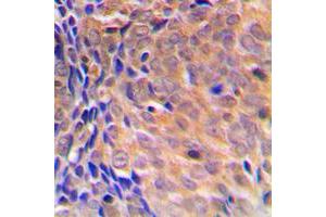 Immunohistochemical analysis of COPS3 staining in human breast cancer formalin fixed paraffin embedded tissue section. (COPS3 antibody  (Center))