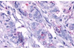 Anti-GPR124 antibody  ABIN1048704 IHC staining of human colon carcinoma, neoplastic cells.