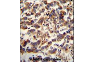 TFAM antibody immunohistochemistry analysis in formalin fixed and paraffin embedded human testis carcinoma followed by peroxidase conjugation of the secondary antibody and DAB staining.