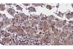 ABIN6273959 at 1/100 staining Human liver cancer tissue by IHC-P.