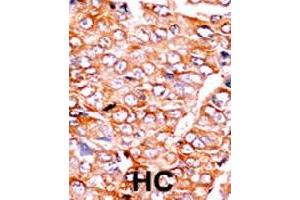 Formalin-fixed and paraffin-embedded human hepatocellular carcinoma tissue reacted with BID (phospho S65) polyclonal antibody  which was peroxidase-conjugated to the secondary antibody followed by AEC staining.