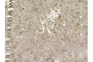 ABIN6257076 and ABIN6275818 at 1/100 staining human melanoma by IHC-P. (Cytochrome P450 2A6V2 (C-Term) antibody)