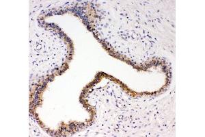 IHC-P: TrkC antibody testing of human breast cancer tissue (NTRK3 antibody  (AA 167-182))