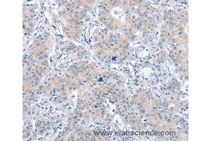 Immunohistochemistry of Human liver cancer using PARD6A Polyclonal Antibody at dilution of 1:60 (PARD6A antibody)