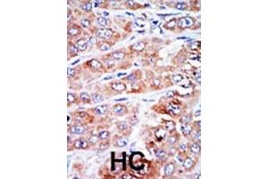 Formalin-fixed and paraffin-embedded human cancer tissue reacted with the primary antibody, which was peroxidase-conjugated to the secondary antibody, followed by DAB staining. (NME4 antibody  (N-Term))