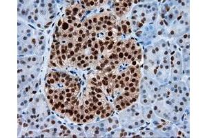 Immunohistochemical staining of paraffin-embedded Adenocarcinoma of colon tissue using anti-KIAA1609 mouse monoclonal antibody. (KIAA1609 antibody)