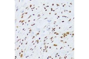Immunohistochemistry of paraffin-embedded human gastric cancer using DDB1 Antibody. (DDB1 antibody)