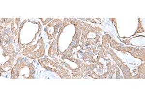 Immunohistochemistry of paraffin-embedded Human thyroid cancer tissue using C9orf116 Polyclonal Antibody at dilution of 1:55(x200) (C9ORF116 antibody)