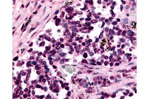 Anti-GPR182 / ADMR antibody IHC of human Lung, Small Cell Carcinoma. (G Protein-Coupled Receptor 182 antibody  (N-Term))