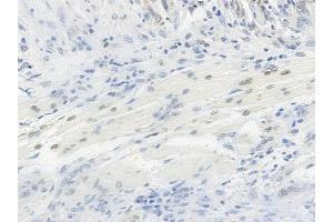 ABIN6254899 and ABIN6267063 at 1/100 staining human tongue carcinoma by IHC-P. (Histone H4 antibody  (H4K12ac))