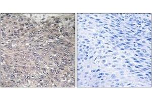 Immunohistochemistry analysis of paraffin-embedded human cervix carcinoma, using Inositol 1, 4, 5-trisphosphate R1 (Phospho-Ser1598/1588) Antibody. (ITPR1 antibody  (pSer1598))