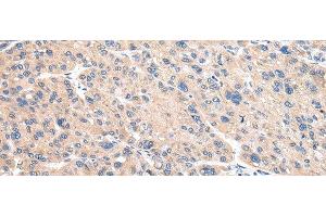 Immunohistochemistry of paraffin-embedded Human liver cancer using VAMP4 Polyclonal Antibody at dilution of 1/30 (VAMP4 antibody)