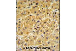 F10 Antibody IHC analysis in formalin fixed and paraffin embedded human hepatocarcinoma followed by peroxidase conjugation of the secondary antibody and DAB staining. (Coagulation Factor X antibody  (C-Term))