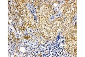 Anti-Vinculin antibody, IHC(P) IHC(P): Human Mammary Cancer Tissue