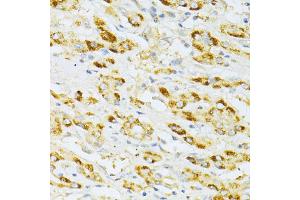 Immunohistochemistry of paraffin-embedded human liver cancer using FLT3 antibody. (FLT3 antibody)