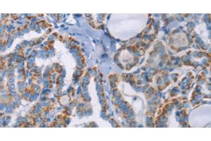 Immunohistochemistry of paraffin-embedded Human thyroid cancer using GPA33 Polyclonal Antibody at dilution of 1:30 (GPA33 antibody)