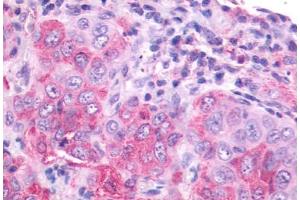 Anti-NMBR antibody IHC staining of human lung, carcinoma. (NMBR antibody  (Cytoplasmic Domain))