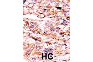 Formalin-fixed and paraffin-embedded human hepatocellular carcinoma tissue reacted with ACVR2A polyclonal antibody  , which was peroxidase-conjugated to the secondary antibody, followed by AEC staining. (ACVR2A antibody  (N-Term))