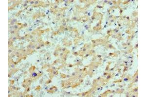 Immunohistochemistry of paraffin-embedded human liver cancer using ABIN7149372 at dilution of 1:100