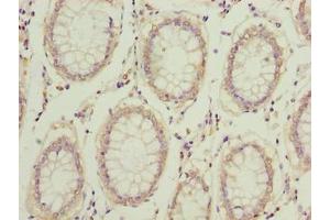 Immunohistochemistry of paraffin-embedded human colon cancer using ABIN7148308 at dilution of 1:100 (COMMD2 antibody  (AA 5-199))