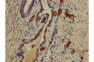 Immunohistochemistry of paraffin-embedded human prostate cancer using ABIN7156227 at dilution of 1:100 (PFAS antibody  (AA 1064-1302))