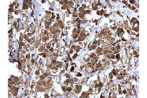 IHC-P Image NFkB p65 antibody detects NFkB p65 protein at cytosol and nucleus on human breast carcinoma by immunohistochemical analysis.