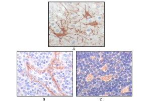 Immunohistochemical analysis of paraffin-embedded human cerebrum tumor (A), endothelium of vessel (B), lymphocyte of thymus(C), showing cytoplasmic localization using FES mouse mAb with DAB staining. (FES antibody)