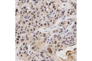 Immunohistochemistry of paraffin-embedded human esophageal cancer using KPNA4 Antibody. (KPNA4 antibody)