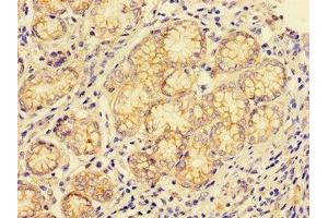 Immunohistochemistry of paraffin-embedded human gastric cancer using ABIN7147004 at dilution of 1:100 (Cathepsin E antibody  (AA 59-155))