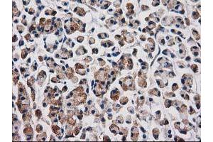 Immunohistochemical staining of paraffin-embedded Adenocarcinoma of Human colon tissue using anti-AQP1 mouse monoclonal antibody.