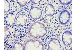 Immunohistochemistry of paraffin-embedded human colon cancer using ABIN7144924 at dilution of 1:100 (ABCE1 antibody  (AA 320-599))