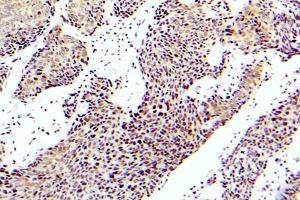 Immunohistochemistry (IHC) analyzes of p-ASK1 antibody in paraffin-embedded human lung adenocarcinoma tissue. (ASK1 antibody  (pSer83))